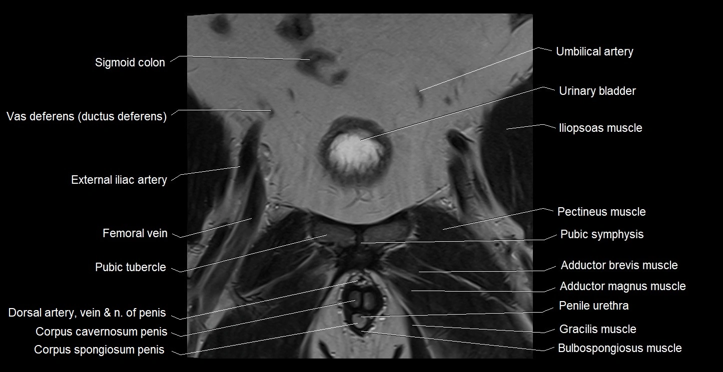 MRI coronal cross sectional anatomy male pelvis image 9.webp